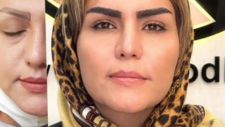 کاشت ابرو در کرج | زیبایی چهره با ابروهای کامل