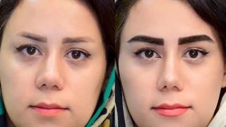 کاشت ابرو در کرج | ابروهای جذاب، چهره‌ای بی‌نظیر