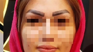 کاشت ابرو در کرج | ابروهای پرپشت، اعتمادبه‌نفس بی‌نهایت