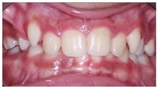 دکتر فرزانه احراری کامپوزیت ونیر