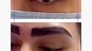 کاشت ابرو در کلینیک آوینا