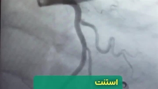 ضایعات و گرفتگی رگ های بینابینی را باید استند گذاری کرد؟