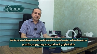 راز لیفت چشم و ابرو بدون جراحی | فیلر شقیقه چطوری عمل می‌کنه؟