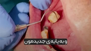 چسب دائم یا موقت برای ایمپلنت بزنیم ؟