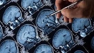 داروی سرطانی که آلزایمر را معکوس میکند