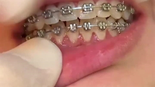 درمان جلو آمدگی فک بالا بدون جراحی فقط و فقط با ارتودنسی