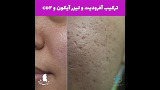 درمان جای جوش با دستگاه پزشکی APHRODITE