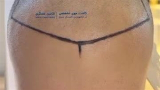 کاشت مو نازنین عسکری در شیراز
