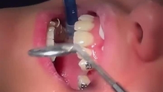 صفر تا صد گذاشتن براکت