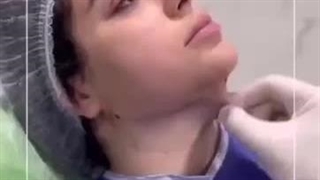 رفع غبغب با لیپوساکشن غبغب – تجربه عملی و نتایج واقعی