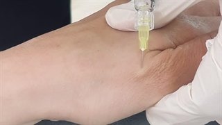 جوانسازی پوست دست