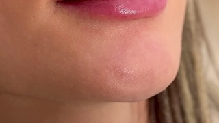 فیلر لب طبیعی و نچرال