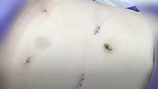 اسلیو معده و زیبایی اندام زیر نظر بهترین جراح پیکرتراشی