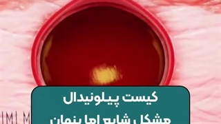 علائم کیست پیلونیدال