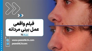 فیلم عمل بینی مردانه - پزشک 24