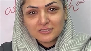 رضایت زیباجوی عزیز بعد از عمل بلفاروپلاستی پلک بالا