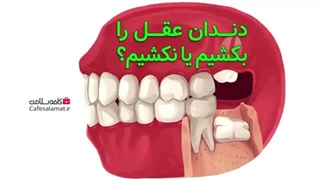دندان عقل را بکشیم یا نکشیم؟