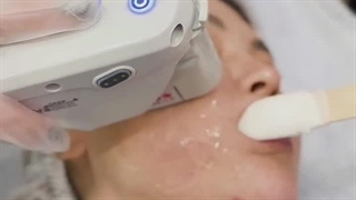 انجام هایفو با هایفو اولترا برای مراجعه کننده عزیزمون