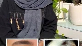 درمان اسکار