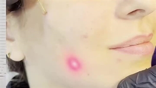 اندولیفت نوین ترین تکنولوژی پزشکی