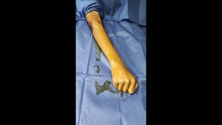 جراحی ترمیم عصب رادیال دست