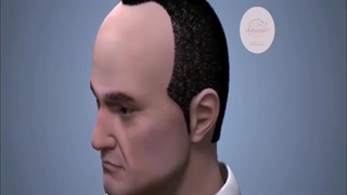 فیلم کاشت مو به روش fut