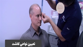 فیلم کاشت مو به روش sut