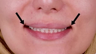 لبخندم روی اعصابمه | قبل و بعد درمان ارتودنسی با دکتر سهراب آصفی