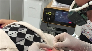 اندولیفت زیر چشم