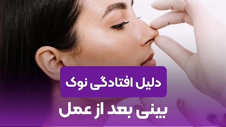 دلیل افتادگی نوک بینی بعد از عمل | علل و پیشگیری از مشکلات بعد از جراحی بینی
