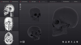 زاویه فک v شکل