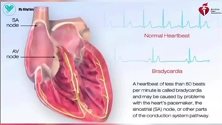 ضربان کند قلب یا برادی‌کاردی