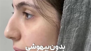 رضایت زیباجوی عزیز از جراحی بینی بدون بیهوشی در درمانگاه مسیح