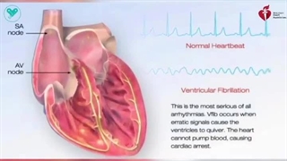 فیبریلاسیون بطنی (Ventricular Fibrillation - V-fib)