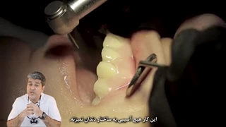 مراحل لمینت دندان از مشاوره تا لبخند نهایی 