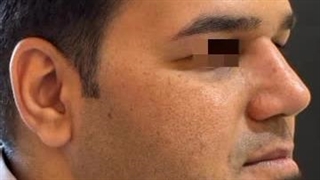 دو ماه پس از جراحی بینی (دکتر ندا سخی)