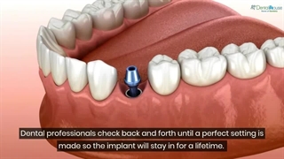 صدای کلیک از ایمپلنت دندان؛ طبیعی یا نشانه خطر؟