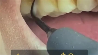 وقتی میگه جرم گیری دندونام رو خراب میکنه!!!! _ کلینیک نوتاش