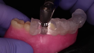 مراحل ایمپلنت دندان از ابتدا تا پایان درمان