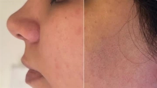 قبل و بعد از ساکشن غبغب