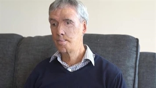 بازسازی صورت مردی 75 ساله با فناوری چاپ سه‌بعدی