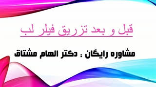 قبل و بعد تزریق فیلر لب