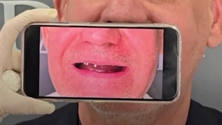 ایمپلنت کل دهان با متخصص ایمپلنت در شریعتی