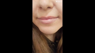 نمونه‌ای از تزریق فیلر لب (9)