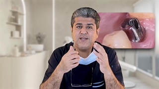 ایمپلنت دندونت لق شده؟ علتش چیه و چطور درستش کنیم | توضیح تخصصی دکتر افشین میرزایی...