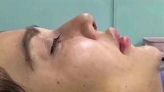 عمل بینی گوشتی زنانه در درمانگاه مسیح