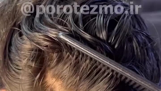 پروتز مو ایران مو | دکتر کیه