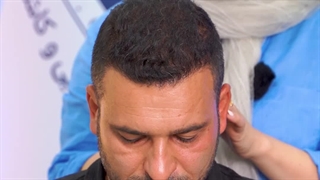 «رشد موها بعد از ۸ ماه از کاشت | نتیجه واقعی در آرمو کلینیک»