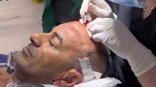 کاشت مو تخصصی فاطمه سینایی