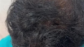 کاشت مو تخصصی ژاله